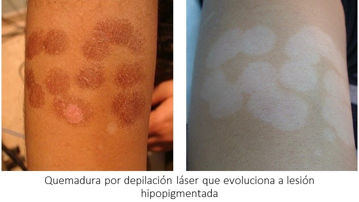 efectos secundarios complicaciones depilacion laser