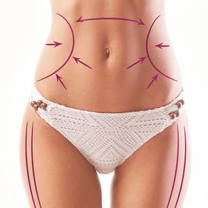 zonas habituales de grasa localizada para tratar con criolipolisis cartucheras abdomen
